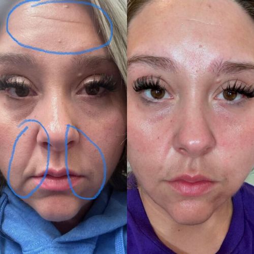 Applying wrinkle patches to smile lines and crow’s feet using Frownies Facial Patches