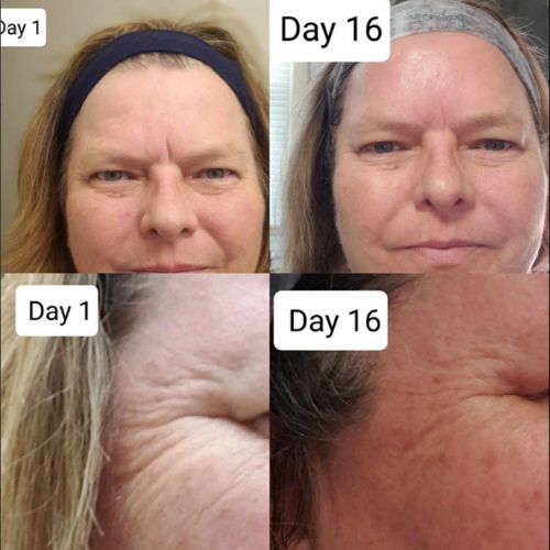 Frownies wrinkle patches results shown over 16 days near eyes and mouth