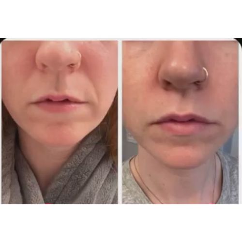 Before and after photos of using Frownies Wrinkle Patches for smile lines