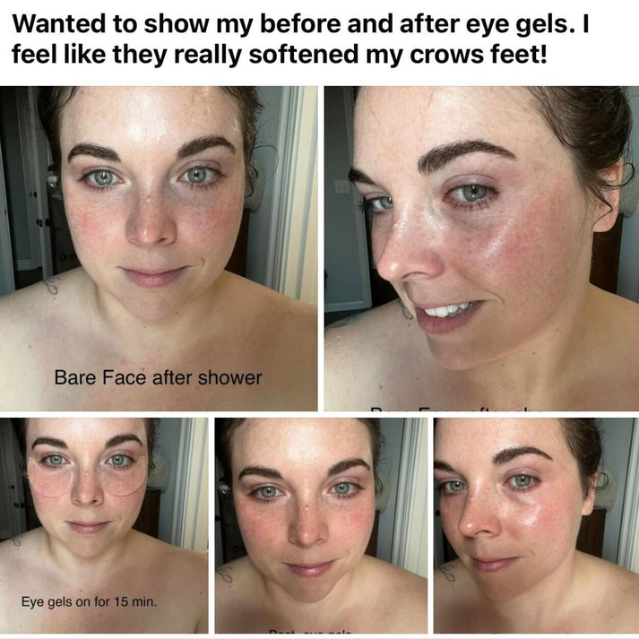 Before and after results using Frownies Under Eye Gels for puffiness