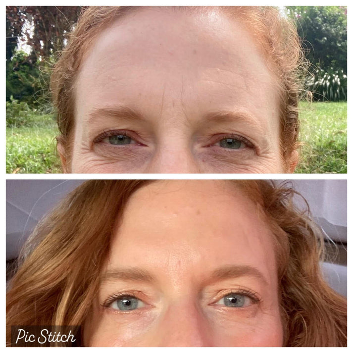 Visible under eye improvement using Frownies Under Eye Gels regularly