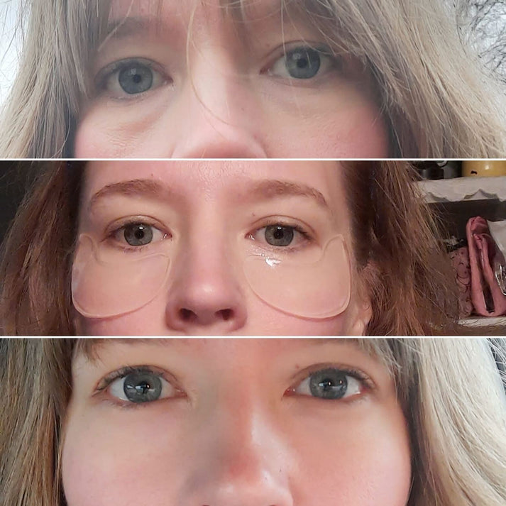 Under eye area brightened after using Frownies Under Eye Gels
