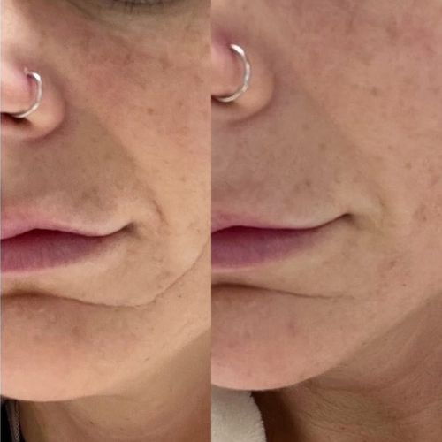 Before and after using Frownies Facial Patches on mouth wrinkles