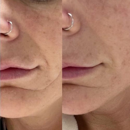 Before and after using Frownies Facial Patches on mouth wrinkles