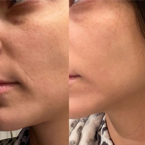 Frownies patches applied to corner of mouth for wrinkle smoothing