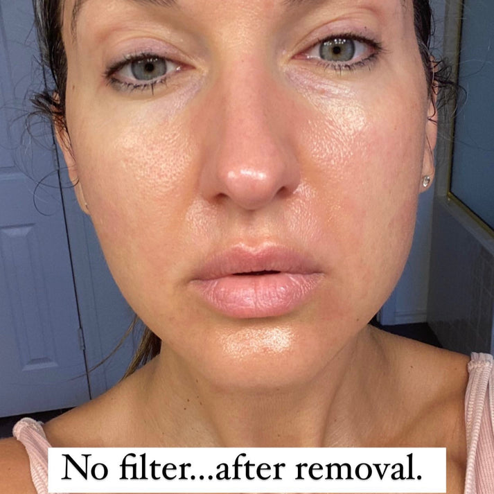 No filter after using Frownies Gentle Lifts for wrinkle reduction